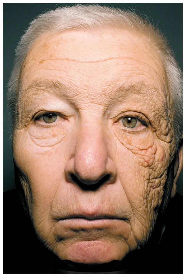 紫外線が肌にもたらす影響は⁉️日焼け対策で老化止め☝🏻 